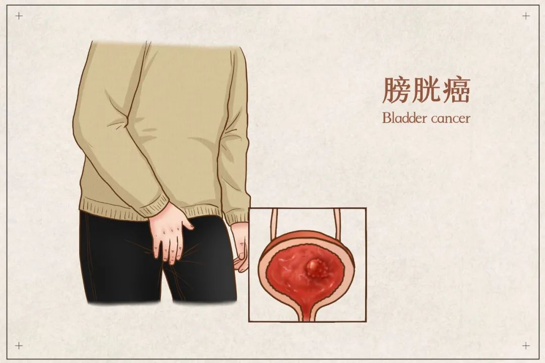 50岁出头的他每天抽两包香烟却查出膀胱癌